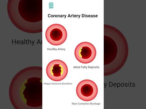 What Is complex coronary artery disease? | #Shorts