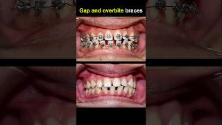 Fix gap and overbite teeth with braces #orthodontist #dentist #dentisty #braces