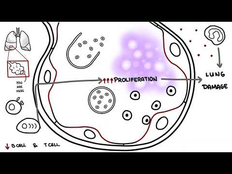 Pneumocystis jirovecii - Pneumocystis pneumonia