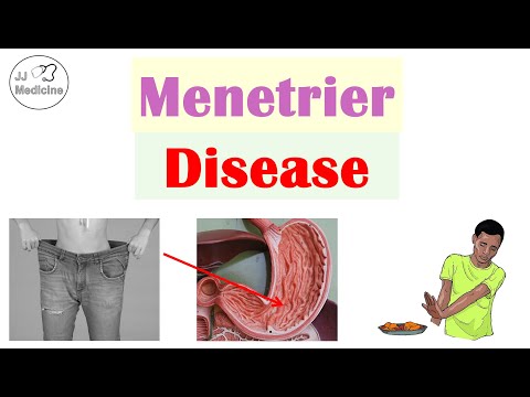 Menetrier Disease | Causes, Pathophysiology, Symptoms, Diagnosis, Treatment