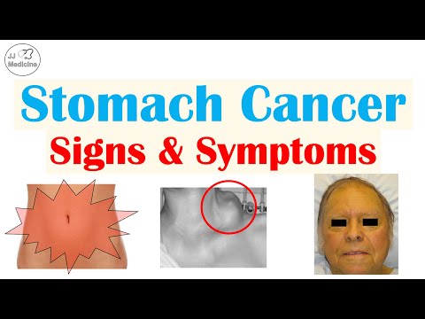 Stomach Cancer Signs and Symptoms | Clinical Manifestations of Gastric Cancer