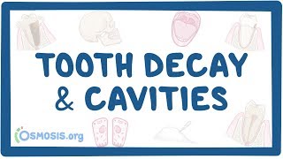 Tooth decay and cavities - causes, symptoms, diagnosis, treatment, pathology