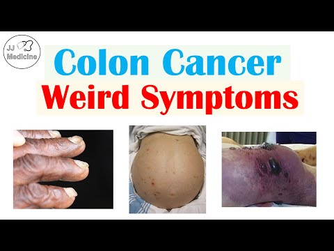 Colon Cancer Weird Symptoms (& Why They Occur)