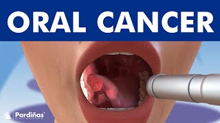 ORAL CANCER and tumors in the mouth, lips and tongue ©