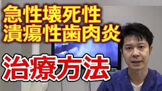 急性壊死性潰瘍性歯肉炎の治療方法について【千葉市中央区の歯医者】