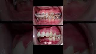 Braces process - Buck teeth