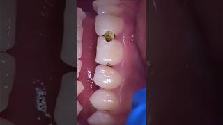 Remove cavity form teeth #dental #caries #cavity #filling