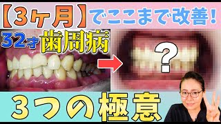 重度歯周病😱【3ヶ月】でここまで改善！３つの極意✨🤩