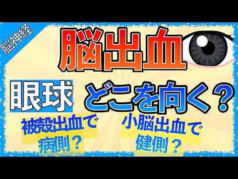 イラストで学ぶ医学！「脳出血の眼球症状まとめ」被殻出血で病側に共同偏視が起こる理由/小脳出血で健側に共同偏視が起こる理由/PPRF