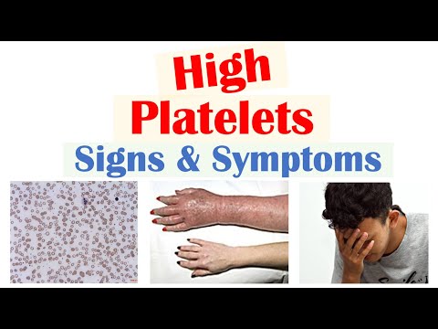 High Platelets (Thrombocytosis) Signs & Symptoms | Rapid Review