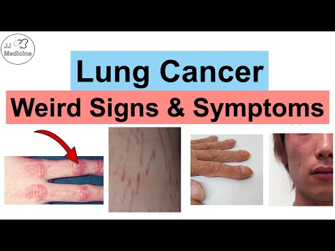 Lung Cancer Weird Signs and Symptoms | Paraneoplastic Syndromes of Lung Cancer