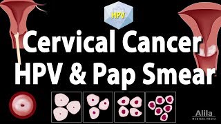 Cervical Cancer, HPV, and Pap Test, Animation