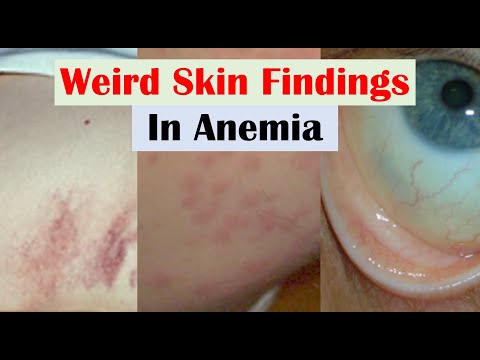 Anemia and Skin Findings (along with Nail Changes and Mouth Sores)