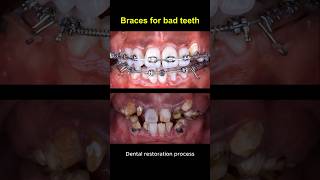 Restore bad teeth and braces #braces #orthodontist #dentist #teeth