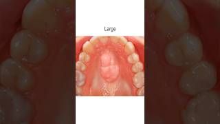 Roof of Mouth Growth (Torus Palatinus) #shorts @fauquierent