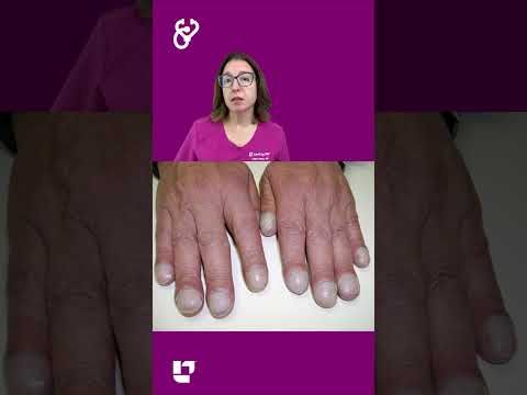 Nail Clubbing: Health Assessment SHORT | @LevelUpRN