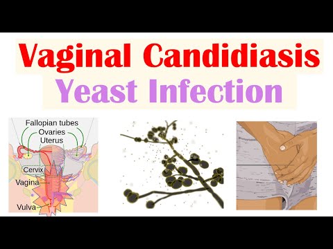 Vaginal Candidiasis (“Yeast Infection”) Causes, Risk Factors, Signs & Symptoms, Diagnosis, Treatment