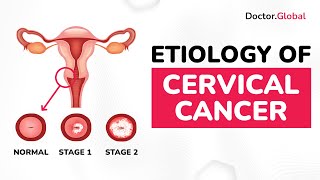 Prevalence, etiology of cervical cancer