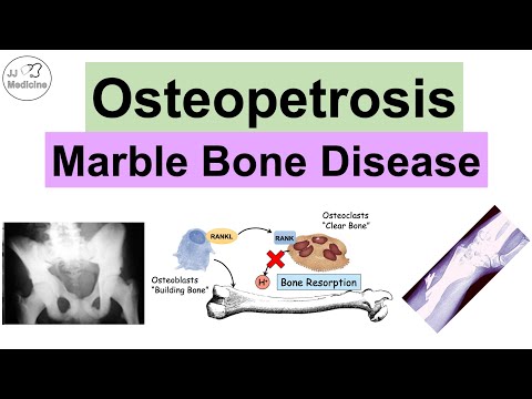 Osteopetrosis (Marble Bone Disease) | Causes, Symptoms, Diagnosis, Treatment