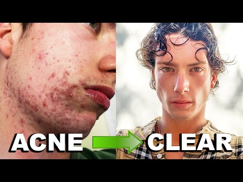 MY ACCUTANE JOURNEY | Clearing 6 Years of Acne (Big Acne Transformation!)