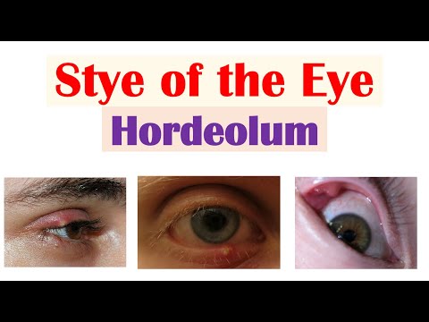 Eye Stye (Hordeolum) | Causes, Symptoms, Diagnosis & At Home Treatments