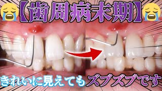 🦷【歯周病末期】🦷きれいに見えても、ズブズブです・・・😨[End stage of periodontal disease] It looks nice, but loose as a goose..