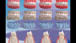 歯肉炎と歯周炎およびその進行 ©