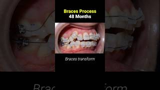 Braces in 48 months #braces #orthodontist #dentist #teeth