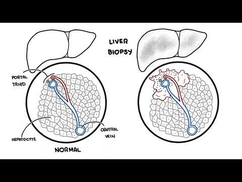 Autoimmune Hepatitis