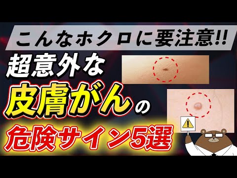 体にこんな「ほくろ」があったら絶対に見逃さないで！皮膚がんの危険な5つのサインとは？