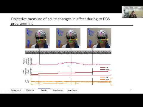 Obsessive Compulsive Disorder (OCD) and deep brain stimulation