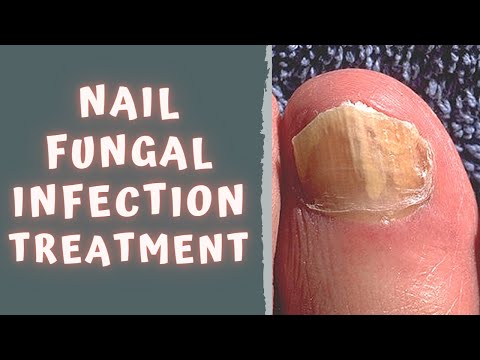 HOW TO TREAT FUNGAL NAIL INFECTION - TINEA UNGUIUM / ONYCHOMYCOSIS