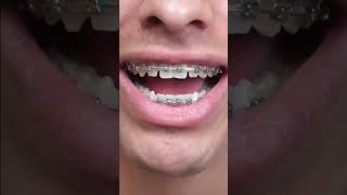 Teeth Feel Loose During Braces - But Is This Normal? 😬