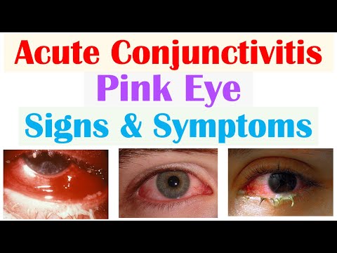 Conjunctivitis Signs & Symptoms (Allergic, Bacterial and Viral) & Why Symptoms Occur