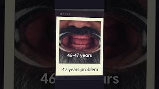 47 Years of Dental Struggles 😰 #toothloss #dentaltransformation #lifechanging #emotional