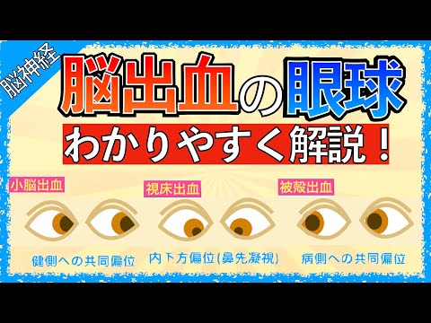 イラストで学ぶ医学！「脳出血の眼球症状まとめ」被殻出血で病側に共同偏視が起こる理由/小脳出血で健側に共同偏視が起こる理由/PPRF