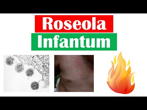 Roseola Infantum (Sixth Disease) | Symptoms (Fever & Rash in Infants), Diagnosis, Treatment