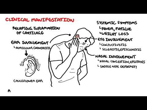 Relapsing Polychondritis