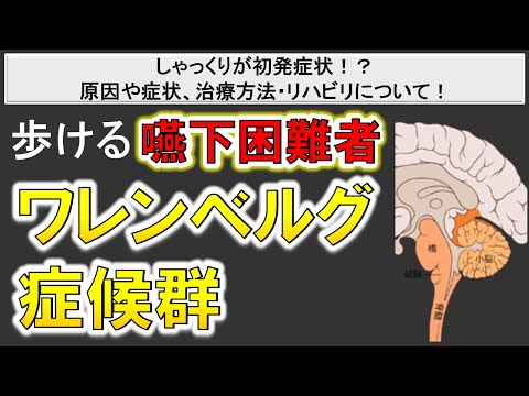 【通常の脳梗塞と比較して若年層にも発症】麻痺が出ない脳梗塞！ワレンベルグ症候群とは？