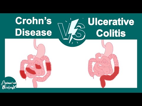 Crohn's disease vs Ulcerative colitis | Pathology | USMLE step 1