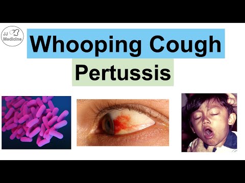 Whooping Cough (Pertussis) | Transmission, Pathophysiology, Symptoms, Diagnosis, Treatment