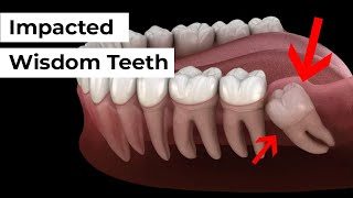 Impacted Wisdom Tooth Removal