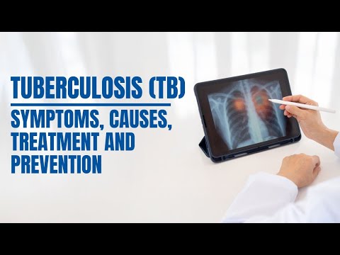 Tuberculosis (TB): Causes, Symptoms, Treatment & Prevention | Medicover Hospitals