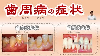 歯周病どのような症状？・歯肉炎症状と歯周炎症状があります