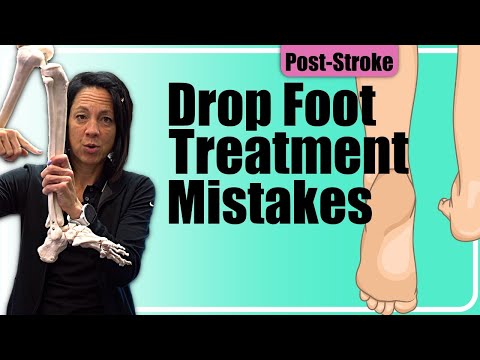 Foot Drop Versus Spasticity Post Stroke