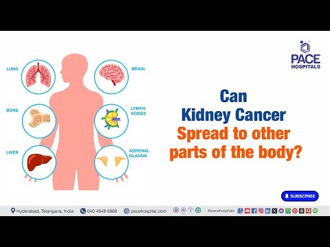 Does Kidney Cancer Spread to other Organs? | Kidney Cancer Metastasis  #kidneycancer