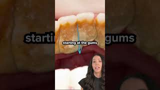 plaque vs tartar on teeth (dental calculus) #shorts