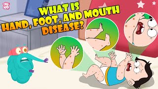 What Is Hand, Foot And Mouth Disease? | Infection In Children | The Dr Binocs Show | Peekaboo Kidz