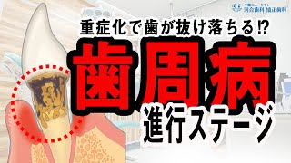 【歯周病】検診で歯肉炎にチェックが入った！歯茎の病気とその進行状態・対応策