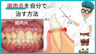 【自宅で実践｜歯肉炎の治し方】市販薬や歯磨き粉を使わず自分で治しましょう。